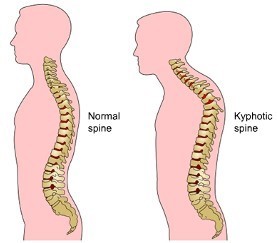 comparison of normal spine and kyphotic spine